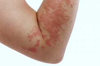 Fexofenadine in higher doses in chronic spontaneous urticaria